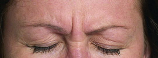 BOTOX1