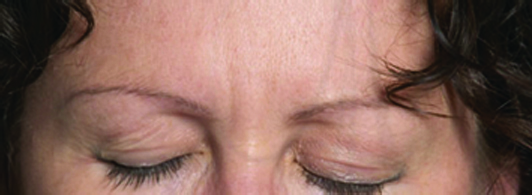 BOTOX2