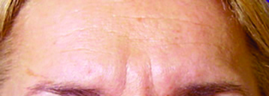 BOTOX3