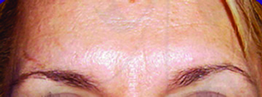 BOTOX4