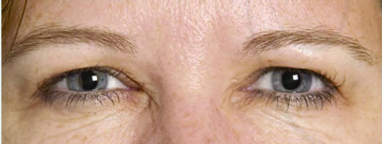 BOTOX6