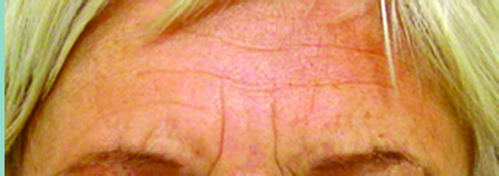 BOTOX7