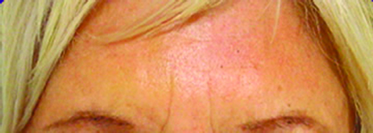 BOTOX8
