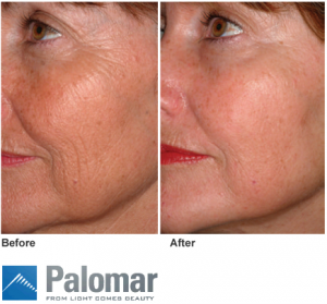 Fractional Laser treatment
