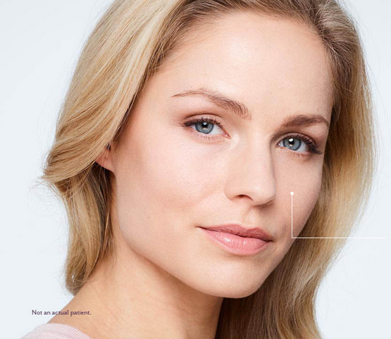 Dermal filler injections